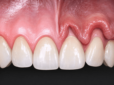 Gingival changes: Stillman’s cleft and McCall’s festoon