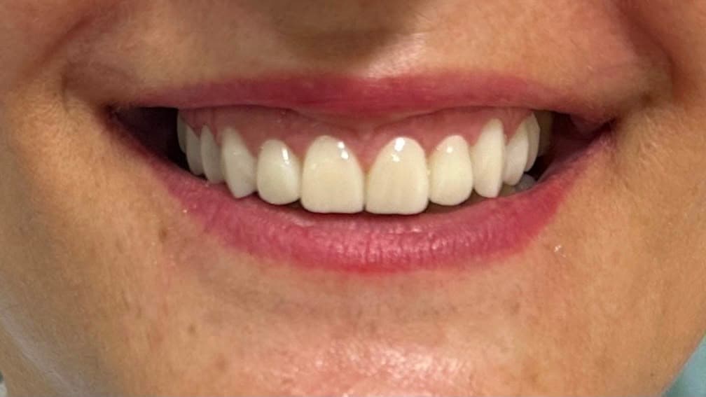 Dental crowns smile case close-up