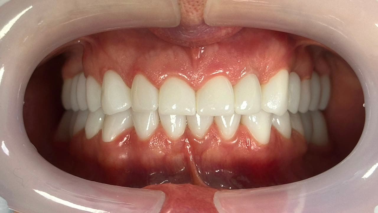 Hollywood Smile dental case close-up