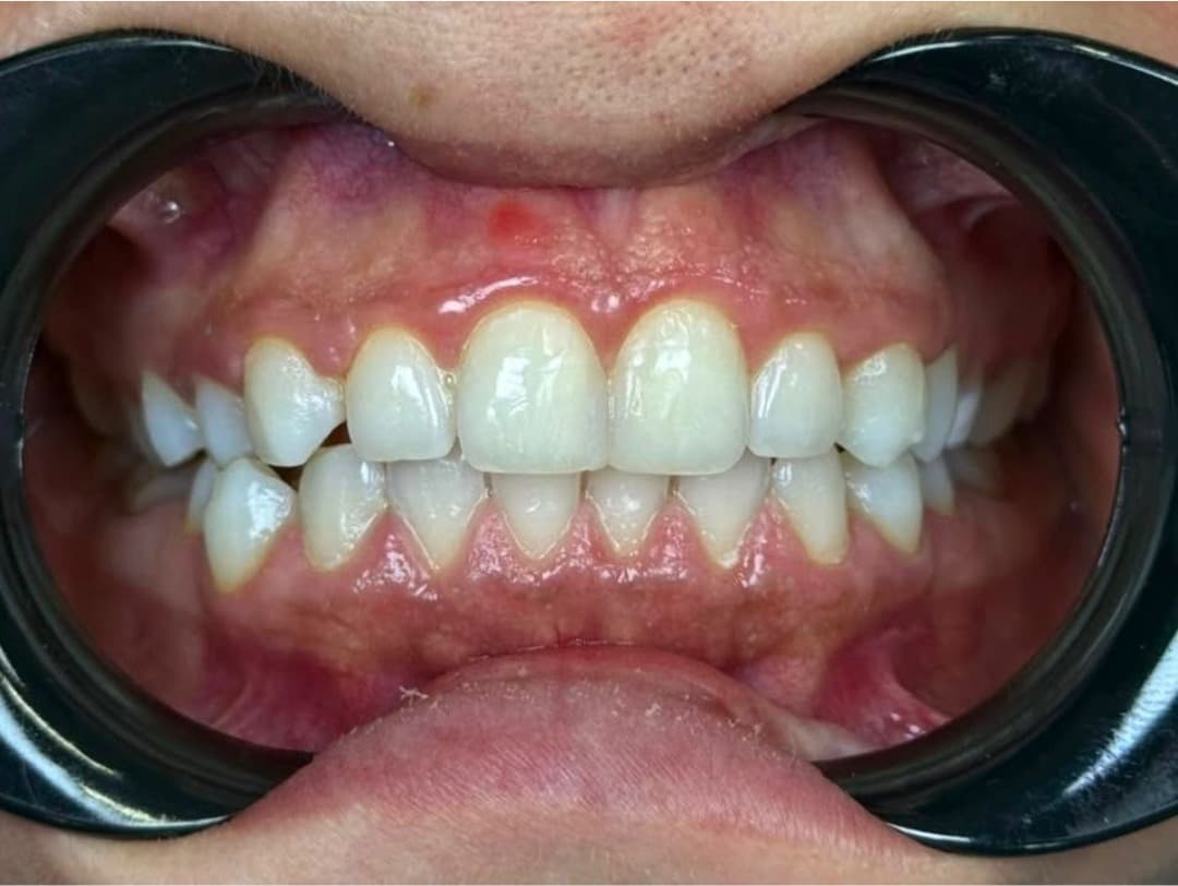 Teeth whitening smile case close-up