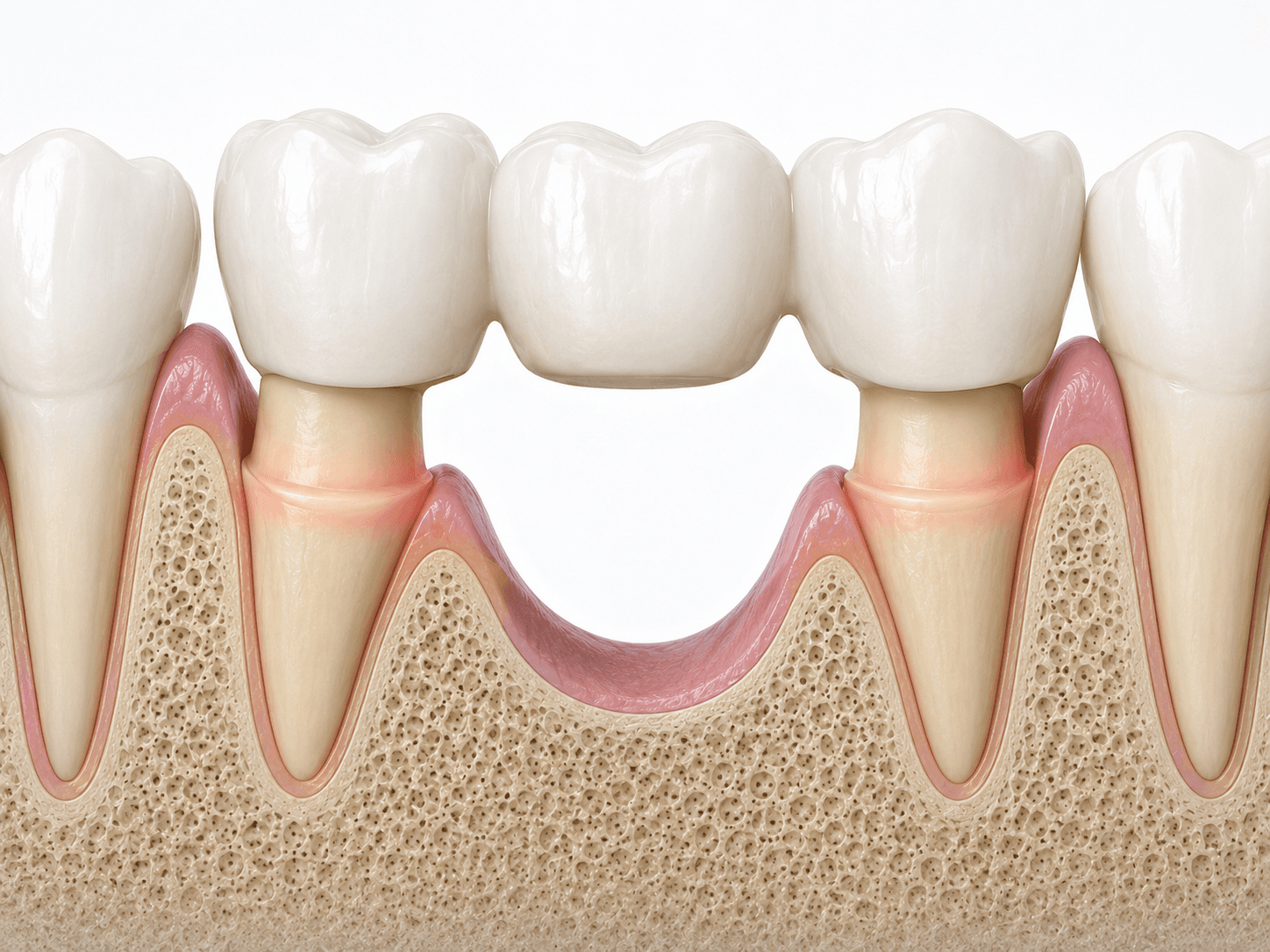 The secret to bone health: why implants are better for the jaw than dental bridges detail 2