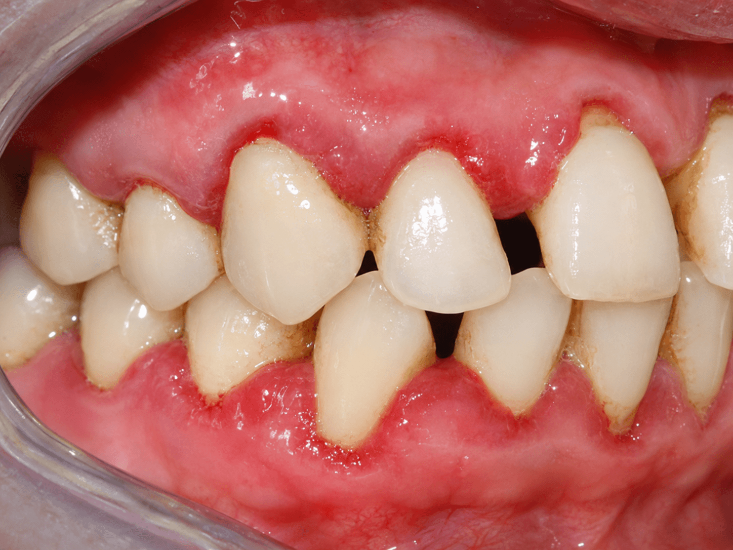 The impact of diabetes on oral health detail 2