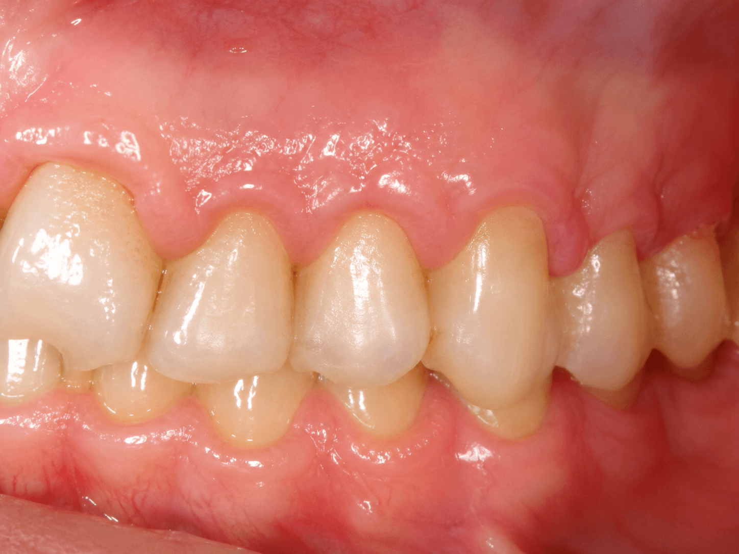 Gingival changes: Stillman’s cleft and McCall’s festoon detail 1