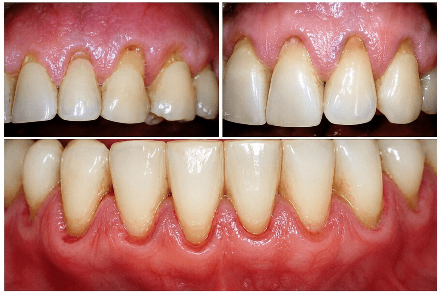 Gingival changes: Stillman’s cleft and McCall’s festoon detail 2
