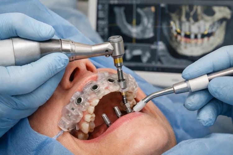 Guided Surgery