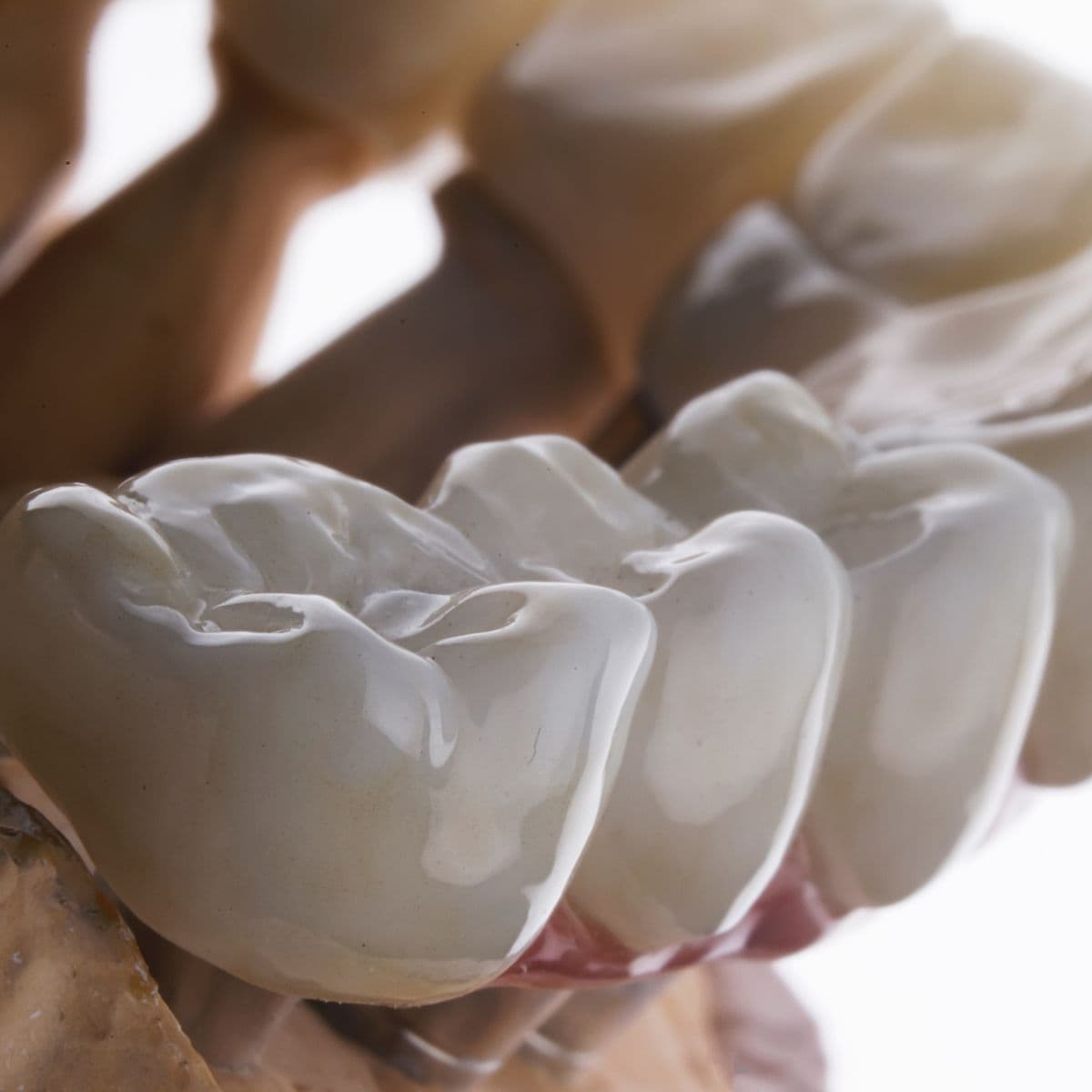 Dental crown on a dental model