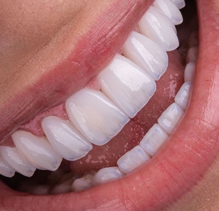 Hollywood Smile veneer result close-up