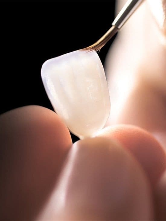 Dental veneer being handled with a brush